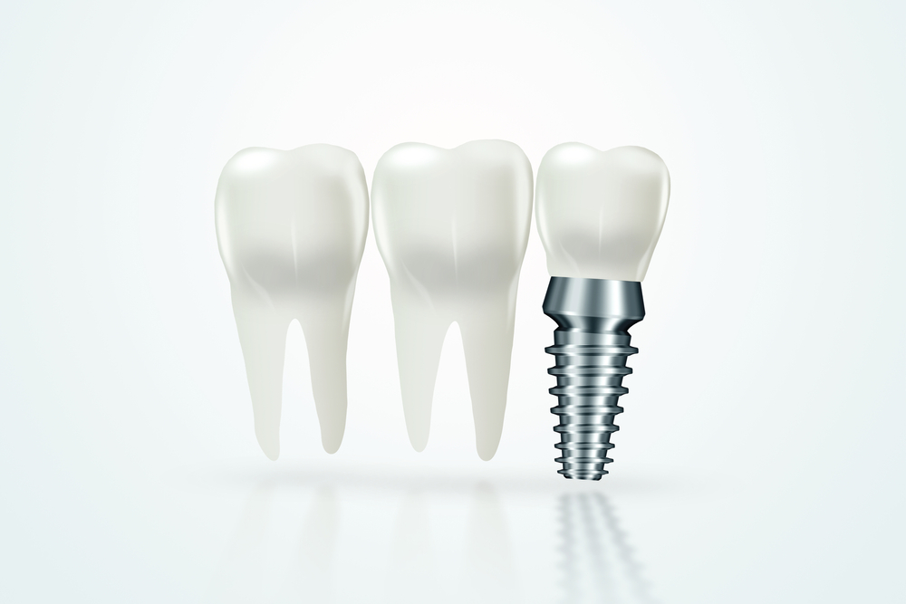 cost of dental implants in Ontario