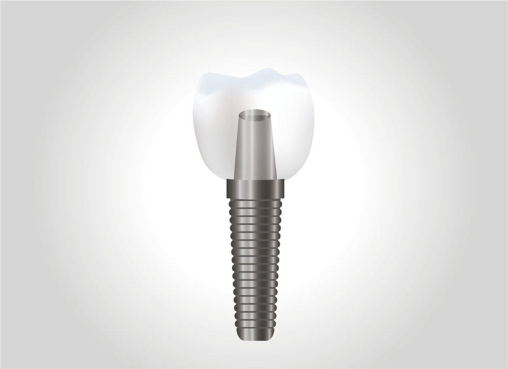 dental implants cost