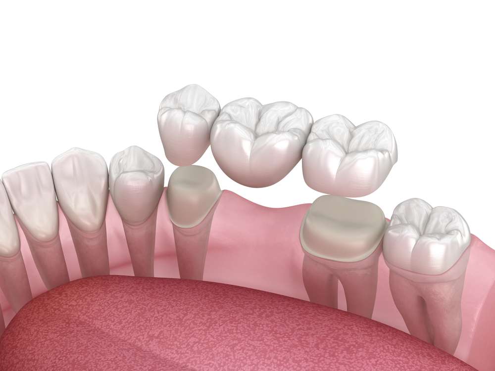 tooth implant vs dental bridge