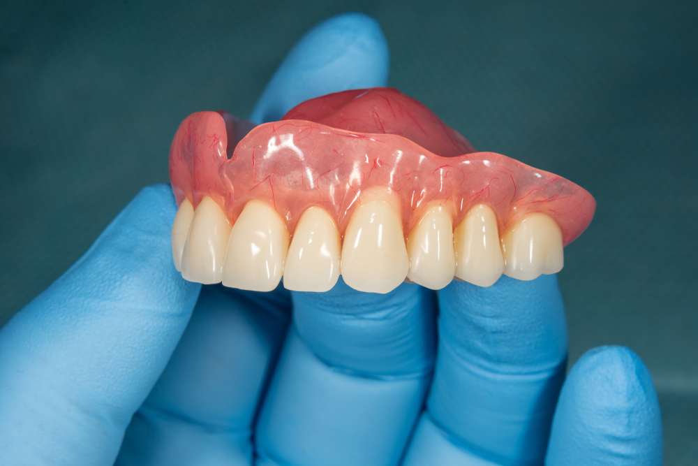 full mouth extraction immediate dentures pictures