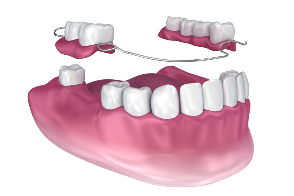 how to make a partial denture